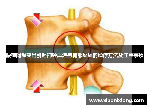 腰椎间盘突出引起神经压迫与腿部疼痛的治疗方法及注意事项